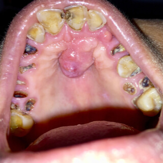 أعراض سرطان الحلق الصلب