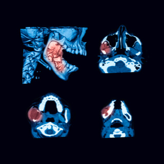 أعراض سرطان الفك السفلي