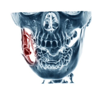 تشخيص سرطان الفك