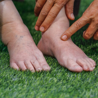 5. احتباس السوائل