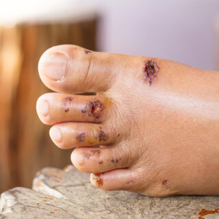 مضاعفات إهمال جروح القدم مضاعفات إهمال جروح القدم