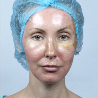 3. التقشير الكيميائي العميق