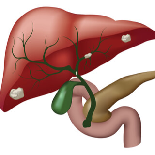 سرطان القناة الصفراوية