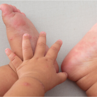 مرض اليد والقدم والفم