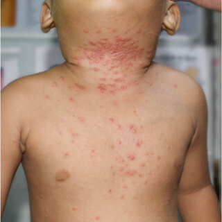 المليساء المعدية