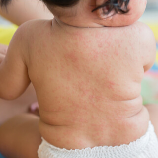 الطفح الوردي