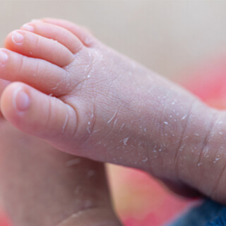 الوقاية من التهاب الجلد التماسي