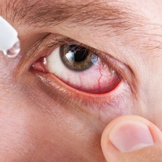 7. حرقة العينين، والحكة، والدموع، والألم 7. حرقة العينين، والحكة، والدموع، والألم