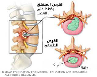 1. انفتاق القرص