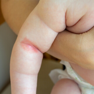 الوقاية من الطفح الجلدي الناتج عن الحرارة