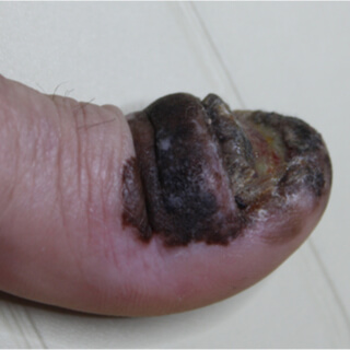 2. تلوّن الإظفر