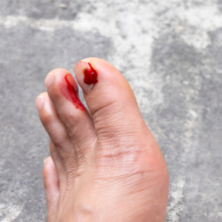 4. نزيف الإظفر 