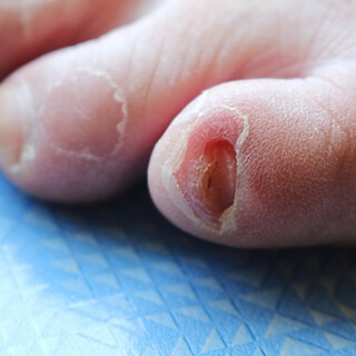 6. اختفاء الإظفر 