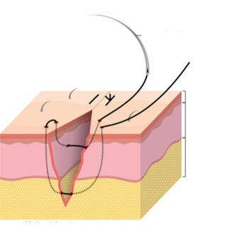 3. الغرز العميقة (Deep sutures)