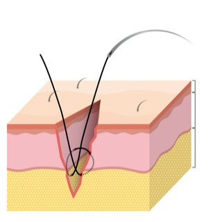 4. الغرز الدفينة (Buried sutures)