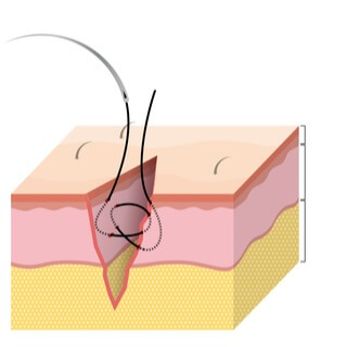 6. الغرز تحت الجلد (Subcutaneous sutures)
