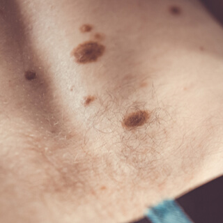 1. الشامات غير النمطية