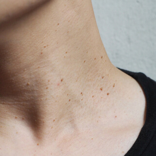 2. الشامات الشائعة