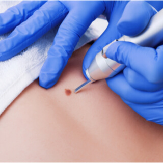 طرق للوقاية من تطور الشامات لأورام خطيرة