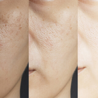 2. التخلص من الرؤوس السوداء والبيضاء 2. التخلص من الرؤوس السوداء والبيضاء