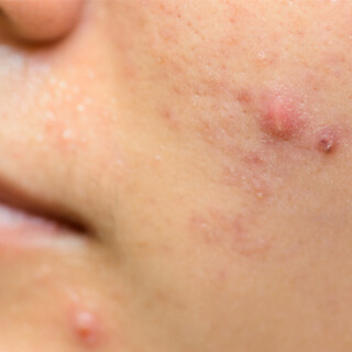 6. تقليل ظهور البثور 6. تقليل ظهور البثور