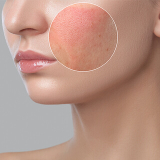 الآثار الجانبية للتقشير بالليزر الكربوني الآثار الجانبية للتقشير بالليزر الكربوني