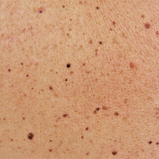 1. الشامات الشائعة 