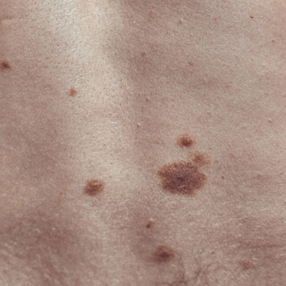 2. الشامات اللانمطية