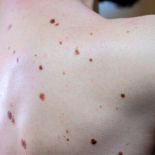 3. الشامات الخلقية