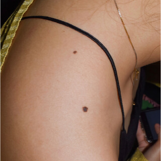 4. الشامات الصباغية الوصلية