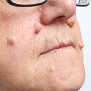 5. الشامات داخل الأدمة