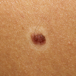 7. شامات هالو