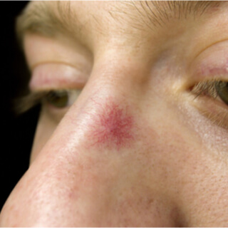 الأورام الوعائية العنكبوتية