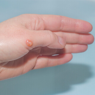 البرفرية الجلدية (Porphyria Cutanea Tarda)