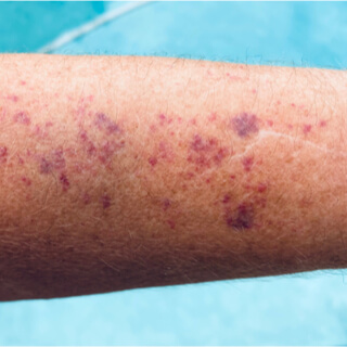 الطفح الجلدي النزفي أو الفرفرية (Purpura)