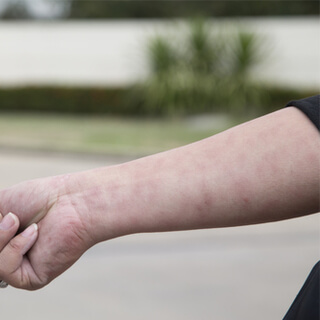 4. الابيضاض المكتنف للجلد