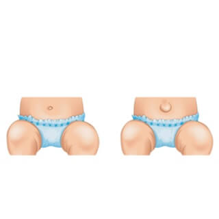 الفتق السري