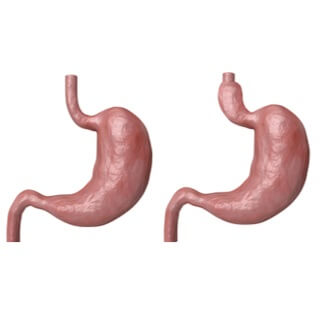 فتق الحجاب الحاجز