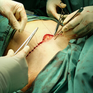 الفتق الجراحي