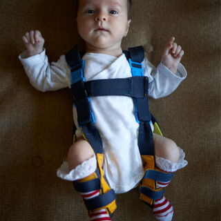 علاج خلع الورك عند الأطفال