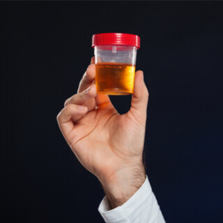 4. البول الداكن