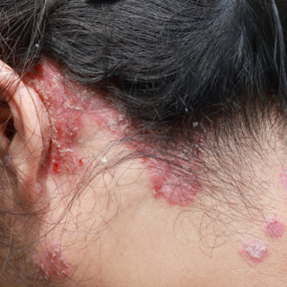 1. صدفية فروة الرأس