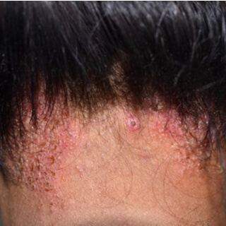 5. التهاب الجلد الدهني