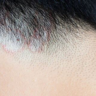 6. سعفة الرأس