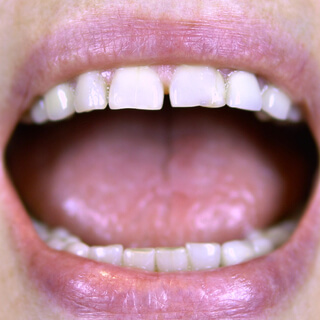 تمرين الضغط باللسان