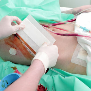 أسباب عملية زراعة الكلى