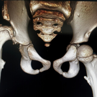 علاج خلع الولادة علاج خلع الولادة