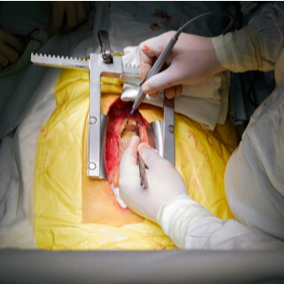 أثناء إجراء عملية القلب المفتوح