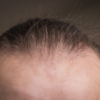 1. الثعلبة الأندروجينية 1. الثعلبة الأندروجينية