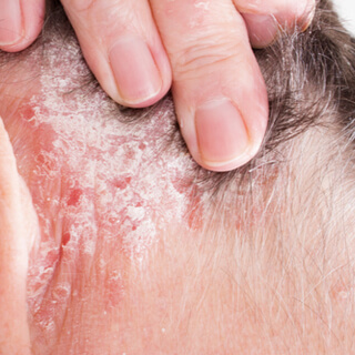 2. الصدفية 2. الصدفية